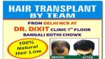 Hair-Transplant-From-Delhi-NCR-at-Dr-Dixit-Clinic-Delhi100%-Natural-Hair-line