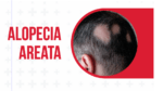 Alopecia-areata-of-diseases