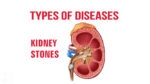 Kidney-Stones